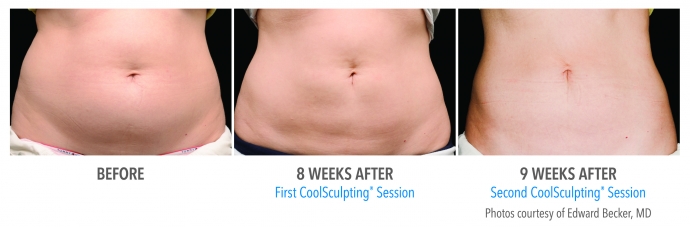 coolsculpting-abdomen-nyc-female-1