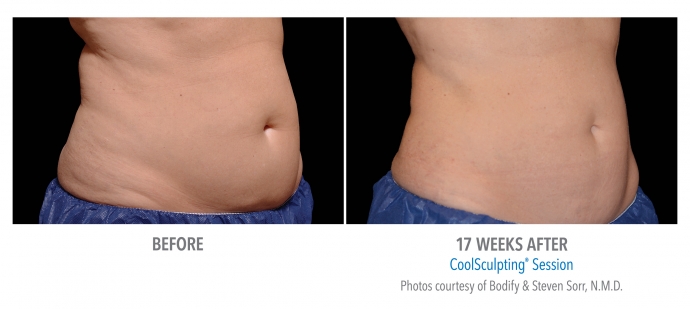 coolsculpting-abdomen-nyc-female-10