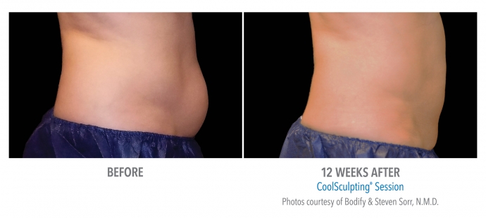 coolsculpting-abdomen-nyc-female-11