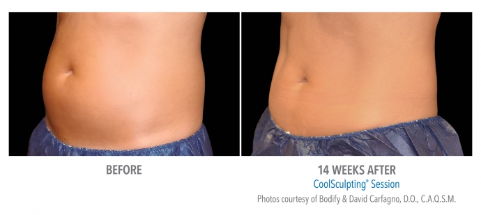 coolsculpting-abdomen-nyc-female-12