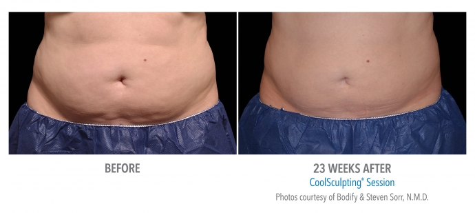 coolsculpting-abdomen-nyc-female-13