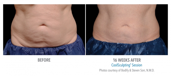 coolsculpting-abdomen-nyc-female-14