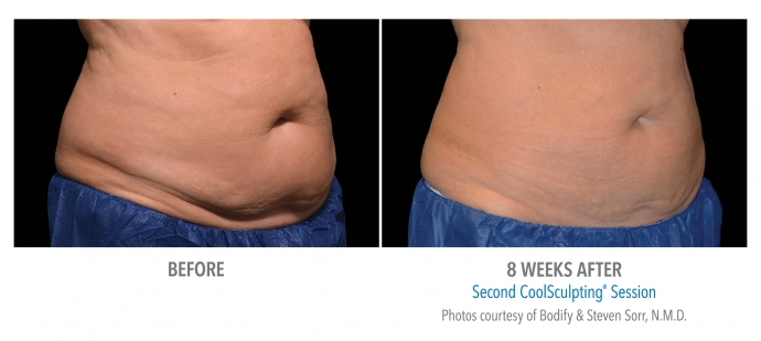 coolsculpting-abdomen-nyc-female-15