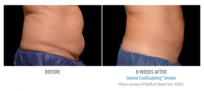 coolsculpting-abdomen-nyc-female-16