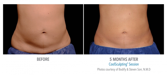 coolsculpting-abdomen-nyc-female-17