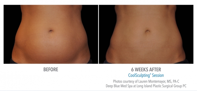 coolsculpting-abdomen-nyc-female-18