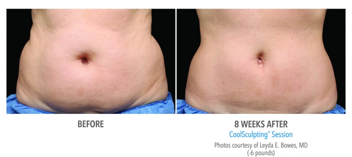 coolsculpting-abdomen-nyc-female-2