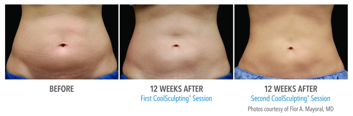 coolsculpting-abdomen-nyc-female-3