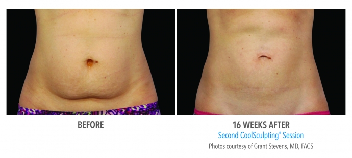 coolsculpting-abdomen-nyc-female-4