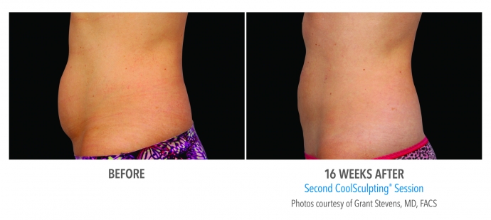 coolsculpting-abdomen-nyc-female-5