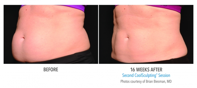 coolsculpting-abdomen-nyc-female-6