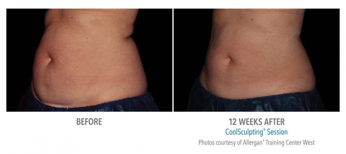 coolsculpting-abdomen-nyc-female-7