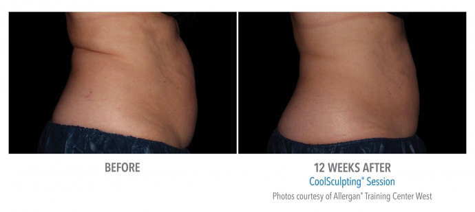 coolsculpting-abdomen-nyc-female-8