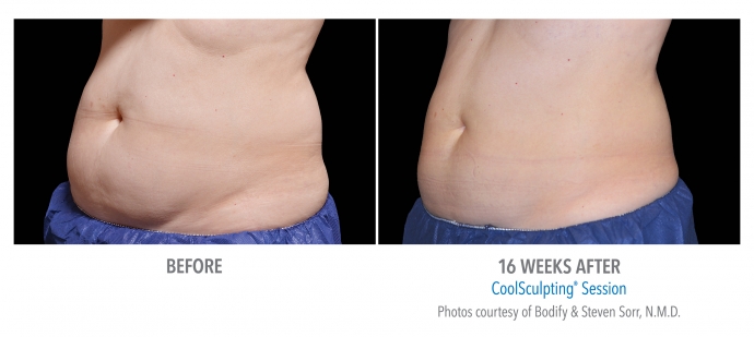 coolsculpting-abdomen-nyc-female-9