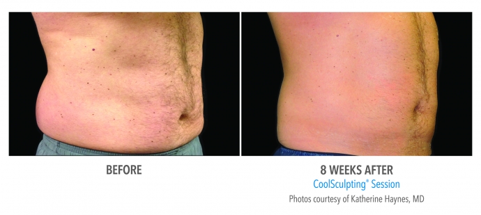 coolsculpting-abdomen-nyc-male-1