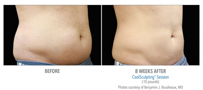 coolsculpting-abdomen-nyc-male-2