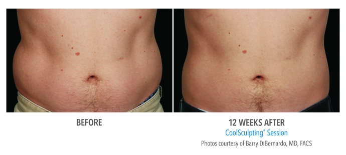 coolsculpting-abdomen-nyc-male-3