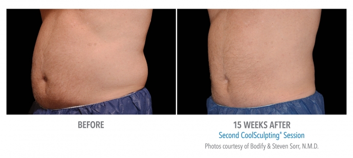 coolsculpting-abdomen-nyc-male-4