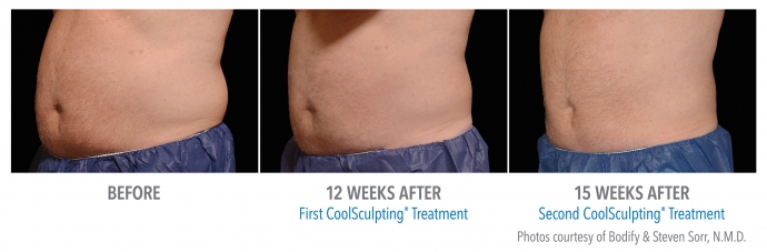 coolsculpting-abdomen-nyc-male-5