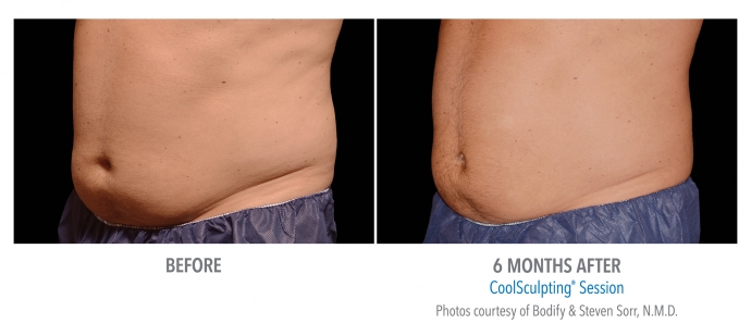 coolsculpting-abdomen-nyc-male-6