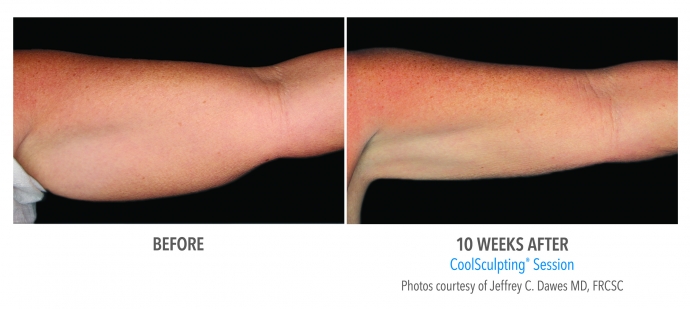 coolsculpting-arms-nyc-female-1