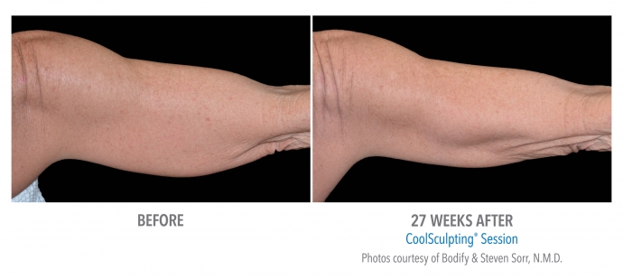 coolsculpting-arms-nyc-female-10