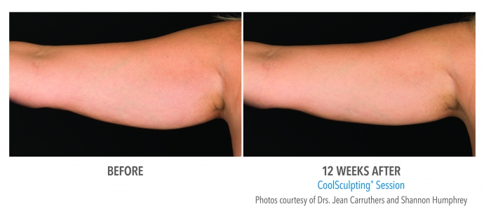 coolsculpting-arms-nyc-female-11