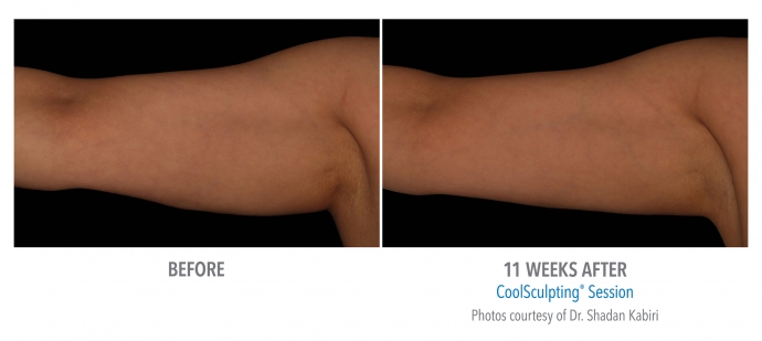 coolsculpting-arms-nyc-female-12
