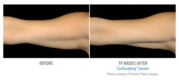 coolsculpting-arms-nyc-female-13