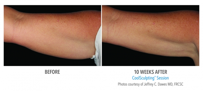 coolsculpting-arms-nyc-female-2