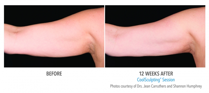 coolsculpting-arms-nyc-female-3