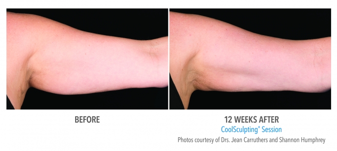 coolsculpting-arms-nyc-female-4