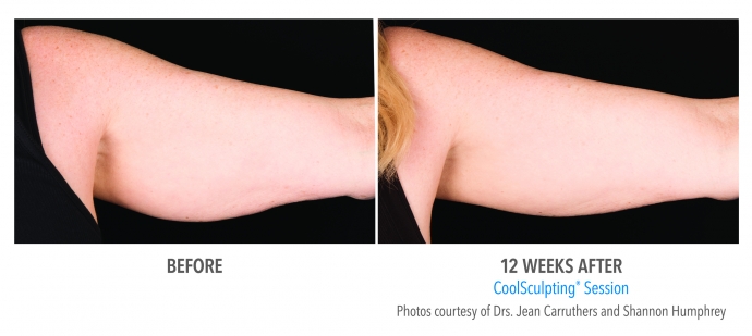 coolsculpting-arms-nyc-female-5