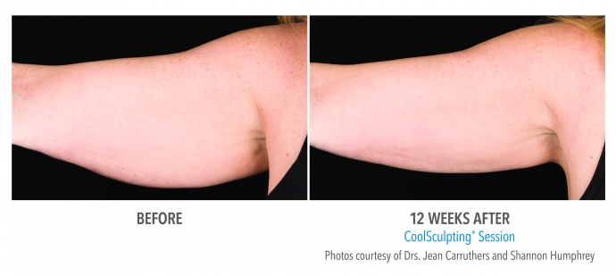 coolsculpting-arms-nyc-female-6