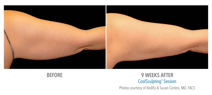 coolsculpting-arms-nyc-female-8