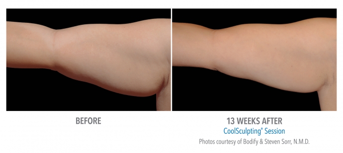 coolsculpting-arms-nyc-female-9