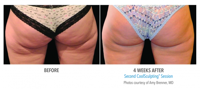 coolsculpting-banana-roll-buttocks-nyc-female-1