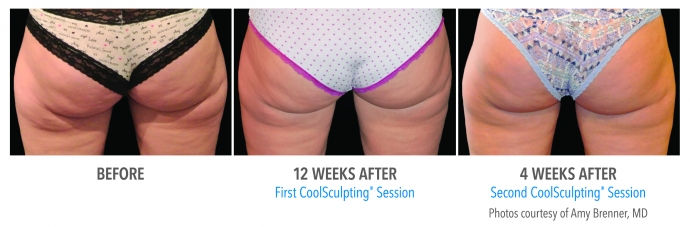 coolsculpting-banana-roll-buttocks-nyc-female-2