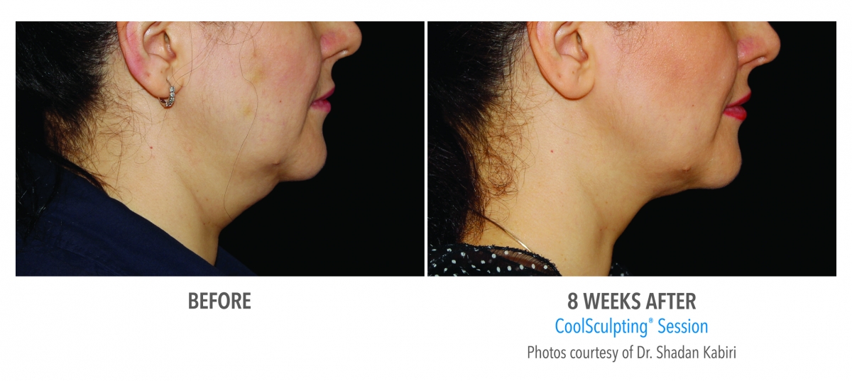 Coolsculpting Face Neck Before And After Photos Nyc 
