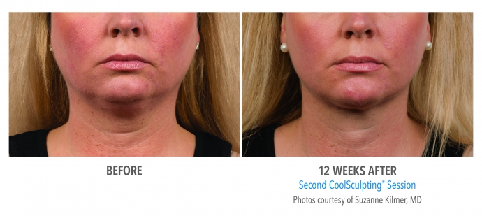 coolsculpting-face-neck-nyc-female-1