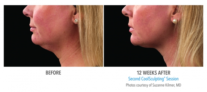 coolsculpting-face-neck-nyc-female-2