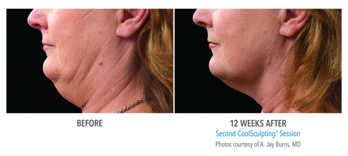 coolsculpting-face-neck-nyc-female-3