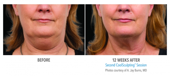 coolsculpting-face-neck-before-and-after-photos-nyc