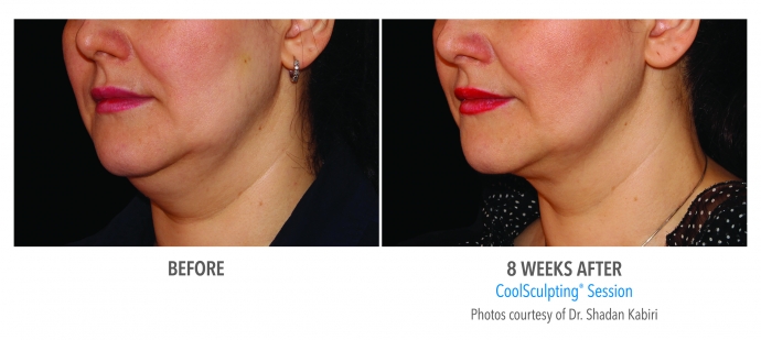 coolsculpting-face-neck-nyc-female-5