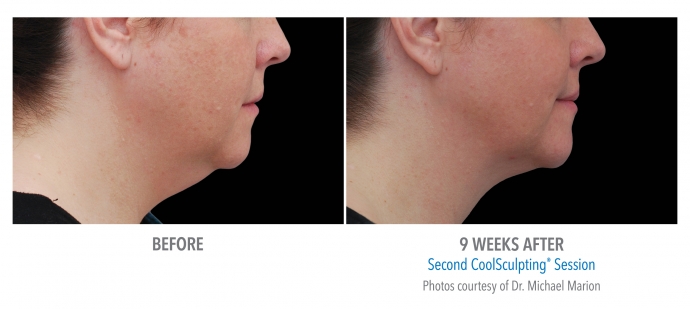 coolsculpting-face-neck-nyc-female-7