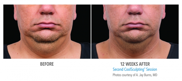 coolsculpting-face-neck-nyc-male-1