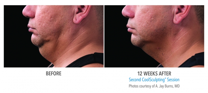 coolsculpting-face-neck-nyc-male-2