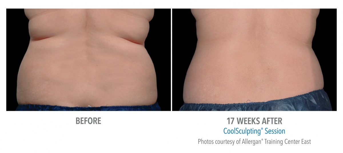 Coolsculpting Flank    Back Before And After Photos Nyc