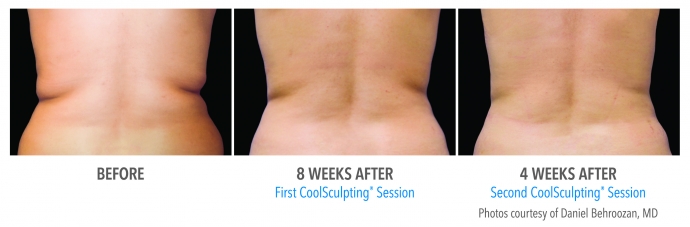 coolsculpting-flank-back-nyc-female-1