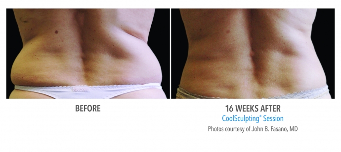 coolsculpting-flank-back-nyc-female-2